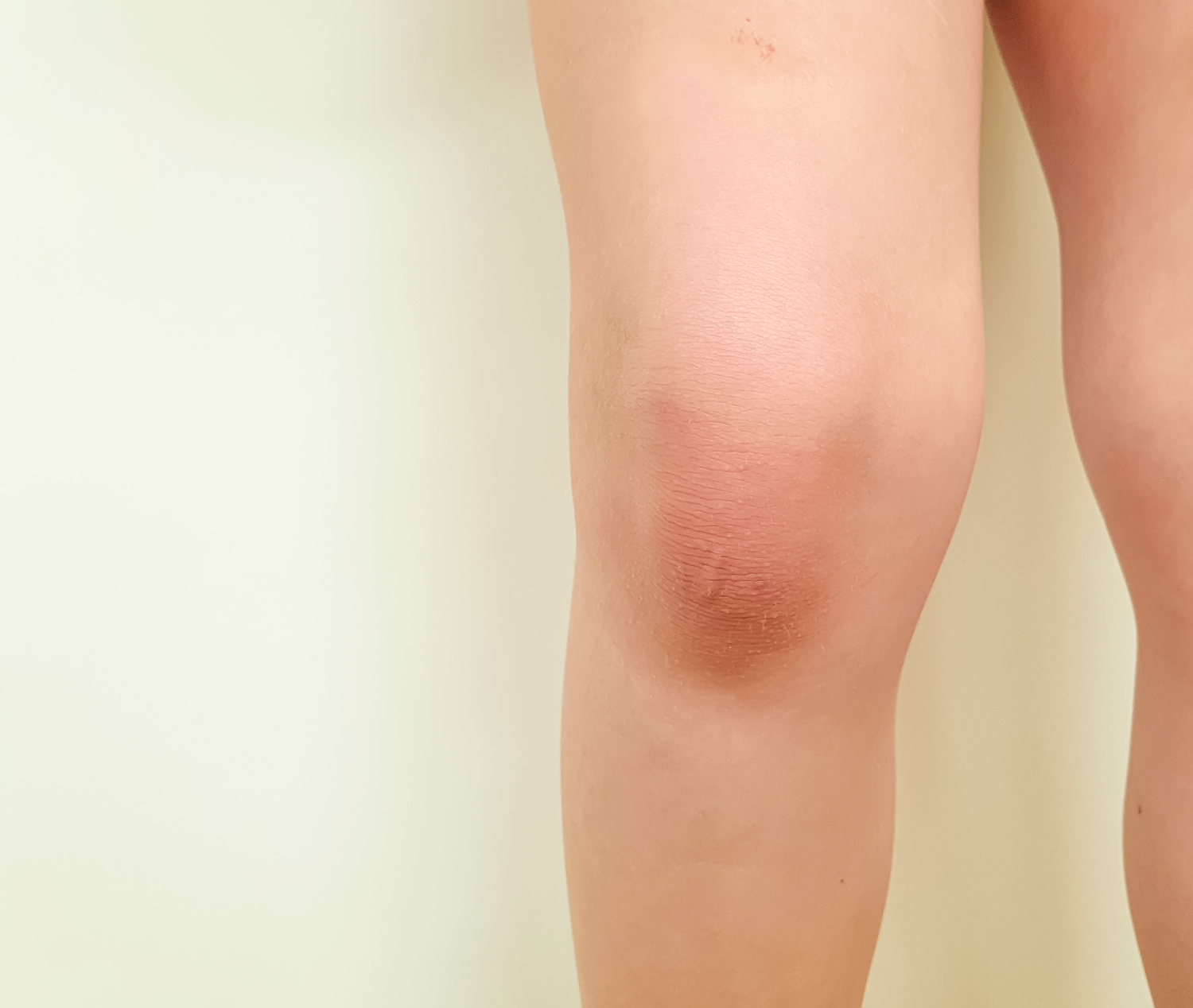 9 Swollen Knees Causes, Say Doctors Why Are My Knees Swollen?