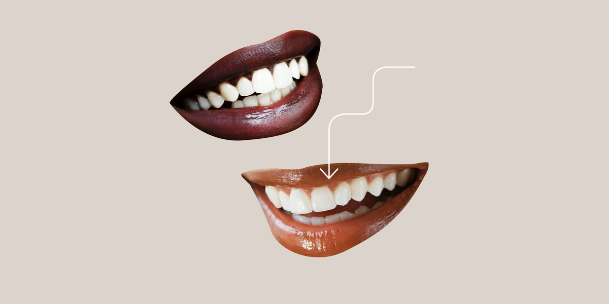 Wanna Try That Veneer Life? Read This Before Making an Appointment